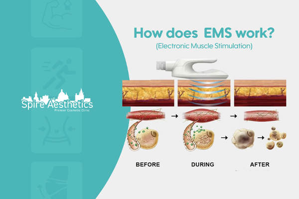EMS treatment for post pregnancy weight loss treatment Bedworth