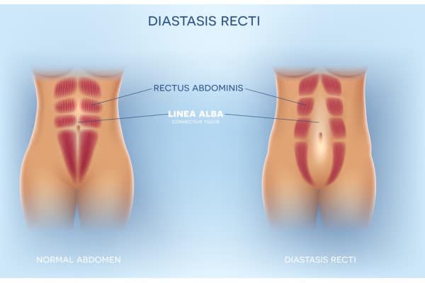 What Non-Surgical Options Are Available for Diastasis Recti Bedworth?