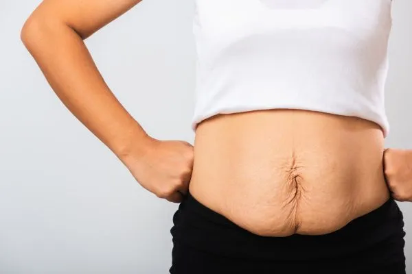 Image of a woman's stomach after weight loss with sagging skin following a gastric band Bedworth
