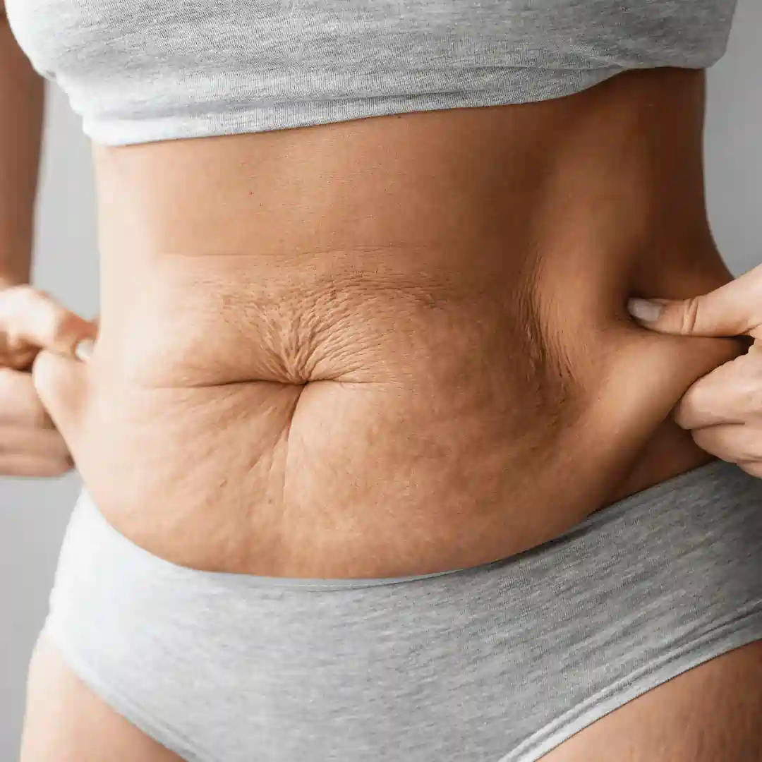 Is It Normal to Have Loose Skin After Pregnancy Bedworth?