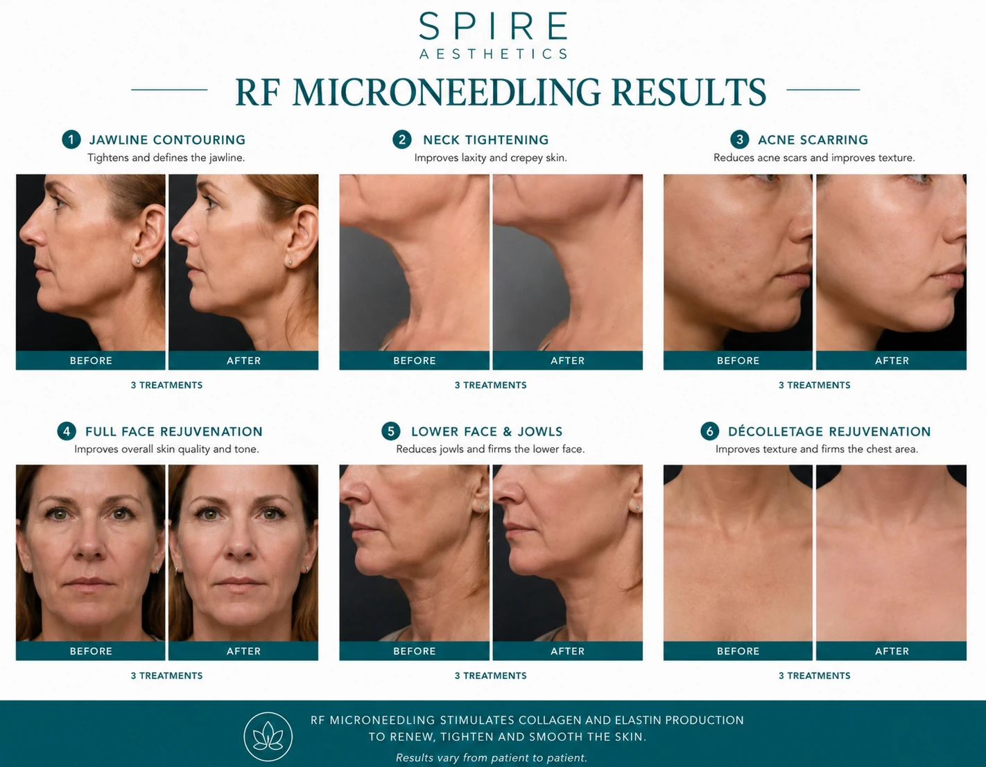 RF Microneedling Skin tightening Bedworth results