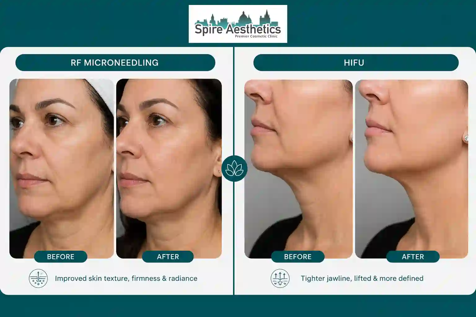 Can RF Microneedling and HIFU Be Combined Bedworth?