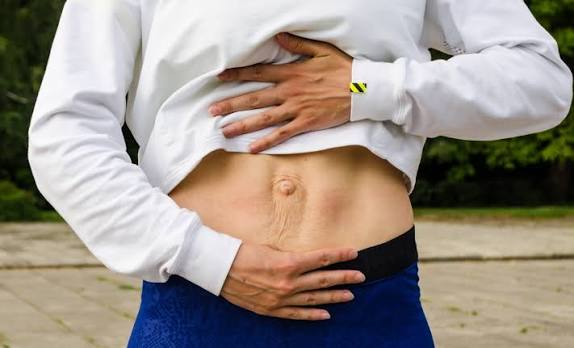 When Could Diastasis Recti Be the Missing Piece of the Puzzle Bedworth?